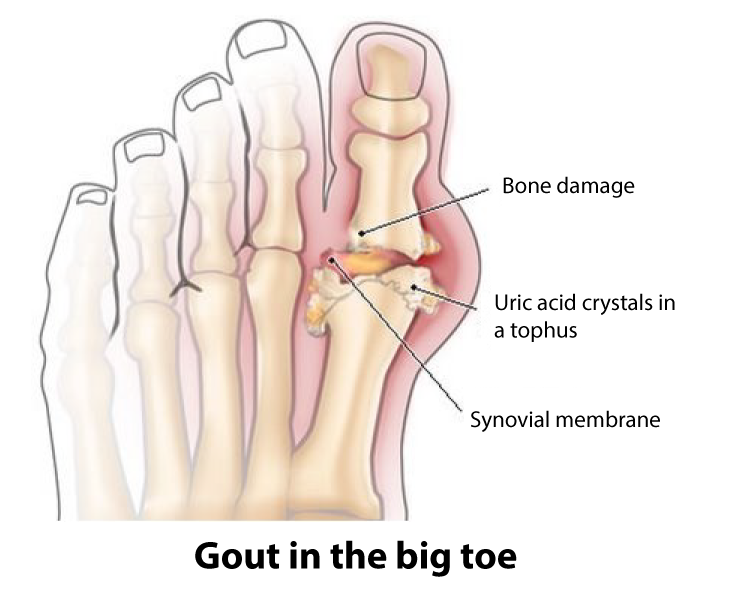 Gout What Is It And What Can I Do About It