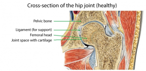 hip arthritis