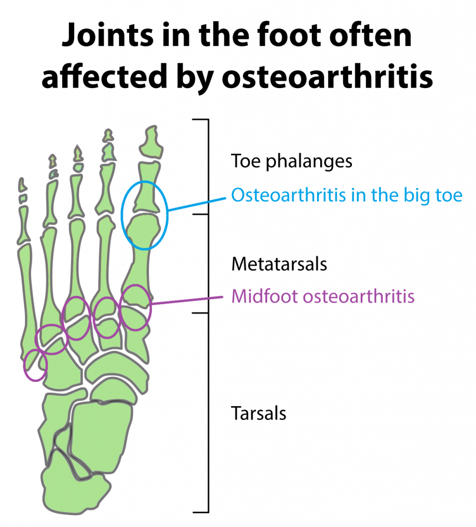 osteoarthritis ankle foot toe