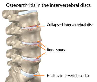 intervertebrális osteoarthritis