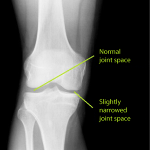 beginning knee arthritis