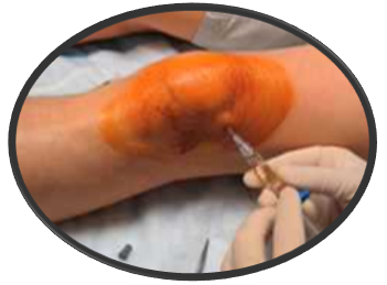 knee injectiob