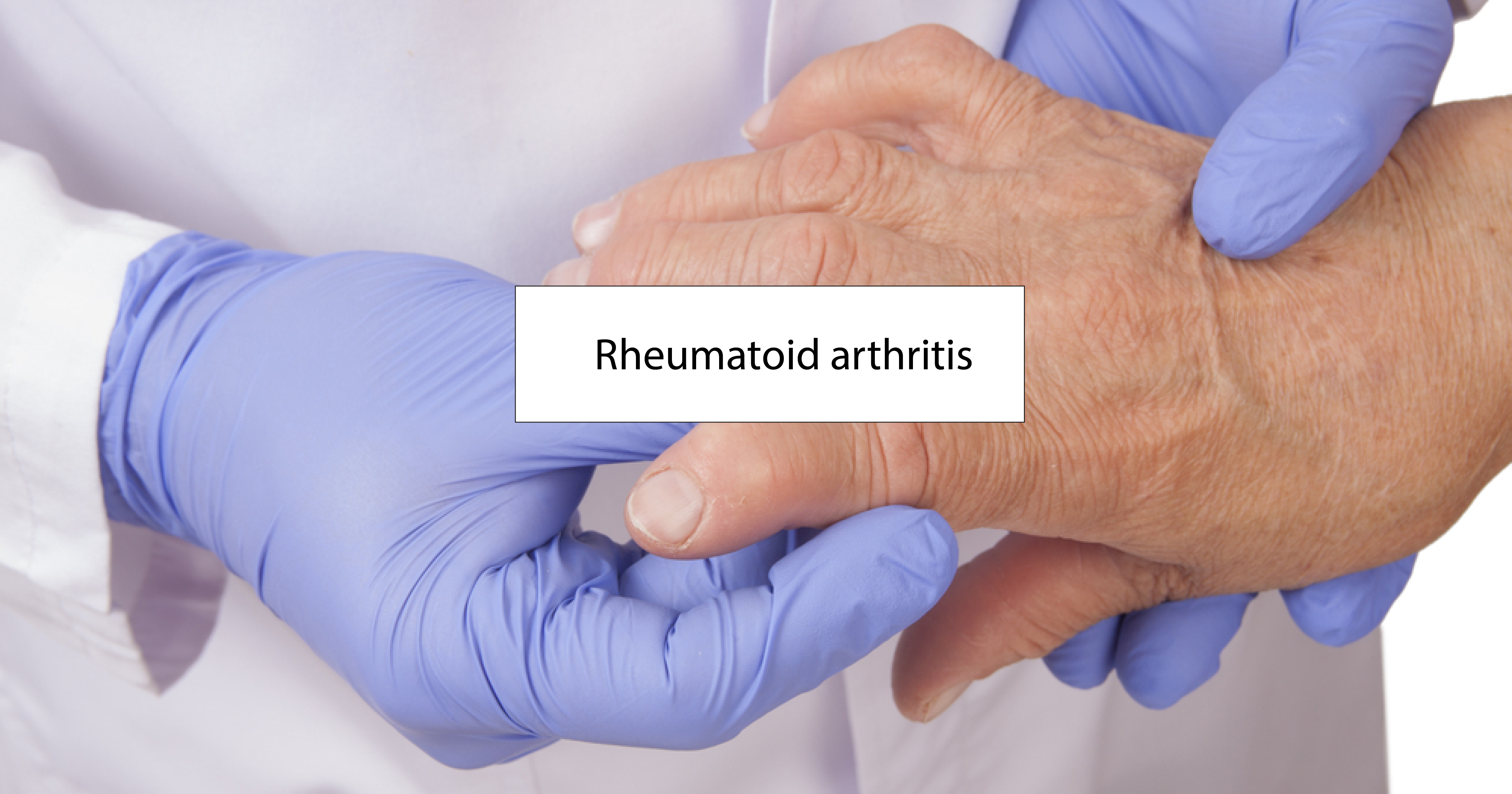 segítség a rheumatoid arthritisben)