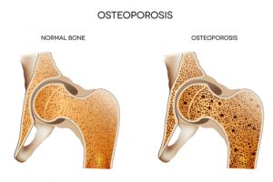 Nutriens Osteoporosis